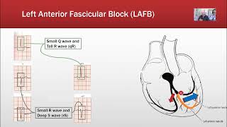 Fasicular blocks [upl. by Jansson]