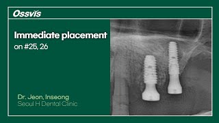 Clinical Case Immediate placement on 25 26 [upl. by Brodench]