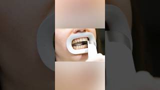 Close up of scanning patients teeth dentist medicalanimation [upl. by Ihana]