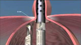 TIF Procedure [upl. by Neidhardt]