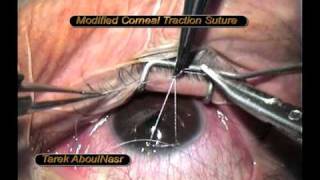 Corneal traction suture in glaucoma modification [upl. by Ohare89]