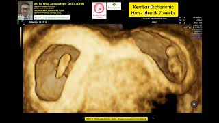 7 Weeks Dichorionic Twins [upl. by Benita210]