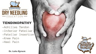 Tendinitis and Tendinopathy Dry Needling Treatment Protocol [upl. by Tarrant]