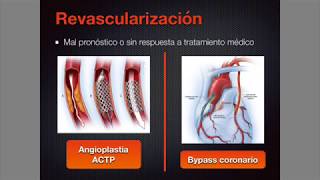 Cardiopatía isquémica 1 ¡Todo lo que debes saber [upl. by Chapa]