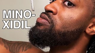 Why I Stopped Using Minoxidil  Does Minoxidil Actually Work [upl. by Ahtnicaj189]