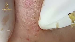 Loan Nguyen Acne Treatment 0288hn [upl. by Barfuss]