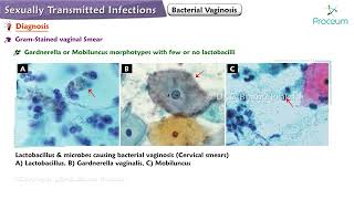 Bacterial Vaginosis Etiology Clinical Features Diagnosis Treatment [upl. by Jablon442]