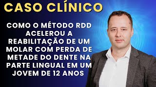 Caso clínico Um Molar com Perda de METADE do Dente na Parte Lingual em um Jovem de 12 Anos [upl. by Jenn331]