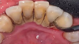 Tartar removal from teeth calculus remove [upl. by Zadoc33]