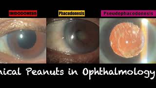 Phacodonesis Vs Iridodonesis Vs Pseudophakodonesis [upl. by Fitting89]