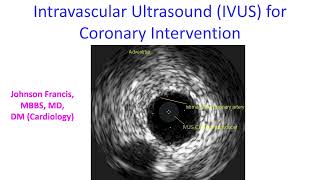 Intravascular Ultrasound IVUS for Coronary Intervention [upl. by Anitsahs]