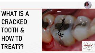 Treatment for cracked teeth [upl. by Colville]