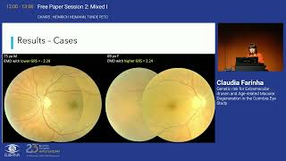 2 Genetic risk for Extramacular drusen and Agerelated Macular Degeneration in the Coimbra Eye Stud [upl. by Amir366]