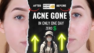 How To Get Rid Of Pimples and Acne Overnight  4 Untold Secrets 🤫🤯 [upl. by Ratep176]