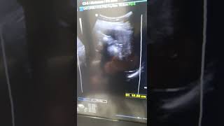 Our spleen on ultrasound imaging health youtubeshorts [upl. by Krid]