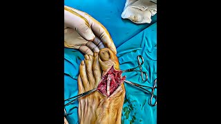 Extensor Hallucis Longus Laceration Repair [upl. by Gweneth]