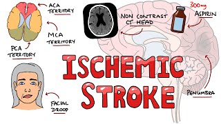 Acute Ischemic Stroke  Signs and Symptoms Stroke Syndromes  Causes amp Mechanisms  Treatment [upl. by December]