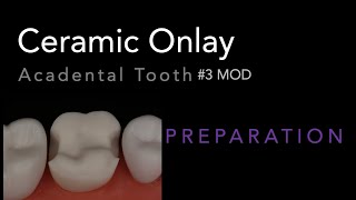 MOD Ceramic Onlay 3 Acadental  Dr Richard Stevenson [upl. by Anilatak]