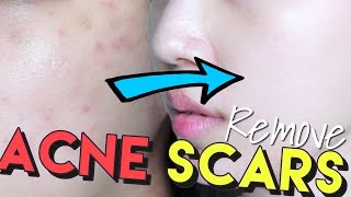 How To Get Rid of Acne Scars amp Hyperpigmentation • Get Brighter Skin [upl. by Afton853]