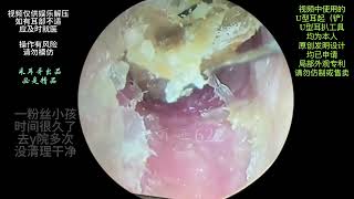 The ear canal is blocked with fungal dry patches [upl. by Nnaoj]