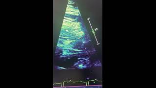 Anomalous tendon in the left ventricular outflow tract well identified [upl. by Aifoz]