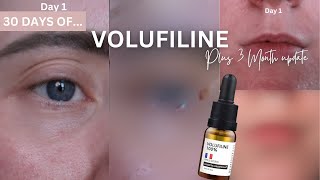 30 Days Of Volufiline As Filler For Eyes amp Lips PLUS 3 MONTH UPDATE [upl. by Atteram398]