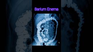 Barium Enema  Barium xray procedure  anatomy radiology xray [upl. by Frederic]