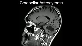 Cerebellar Astrocytoma [upl. by Lebana]