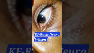 Kayser  Fleischer ring  Wilsons disease [upl. by Weissberg]