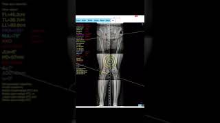 Osteotomy App [upl. by Gnurt]