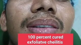 100 percent cured exfoliatve cheilitis treated by Laser and some medicines [upl. by Rombert71]