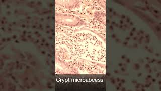 Gland crypt micro abscess in ulcerative colitis [upl. by Ettenal]