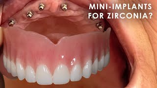 Are MiniImplants Good for FullMouth Zirconia [upl. by Jessabell]