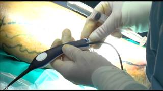 VARICES TRATAMIENTO ENDOVASCULAR POR RADIOFRECUENCIA [upl. by Eylsel]