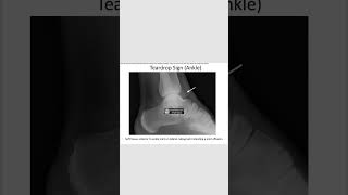 Teardrop signjoint effusionradiology orthopedics neetpg inicetshortsfeed [upl. by Frederik]