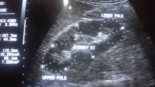 ULTRASOUND PYELONEPHRITIS acute part 1 [upl. by Htims]