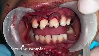 Teeth avulsion and reimplantation using orthodontic retention wire [upl. by Onitselec]