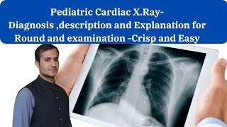 pediatric cardiac Xray for exam Diagnosis description and explanation radiology [upl. by Dur679]