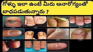 10 Things your nails tell about your Healthtelugu [upl. by Gervais]