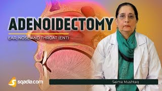 Adenoidectomy  Indications  ENT Video Lectures  Medical Education  VLearning [upl. by Georg]