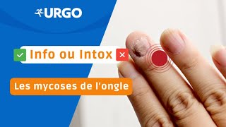 Info ou Intox  Les mycoses de l’ongle  URGO [upl. by Sirroned]