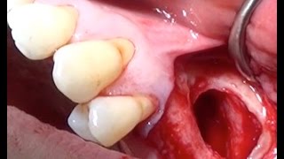 Maxillary Sinus liftSurgical Video [upl. by Maya]