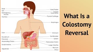 What Is a Colostomy Reversal [upl. by Hugibert666]