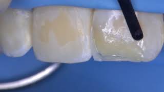 How to create an anterior restoration with multiple Mosaic composite shades [upl. by Aicrag]