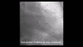 LCX CTO Ipsilateral epicardial colleteral [upl. by Akaya]