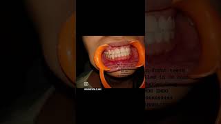 gap treatment in front teeth by DrGunjan Garg MDS ENDO dentist bestkidsdentist smile lase [upl. by Enom]