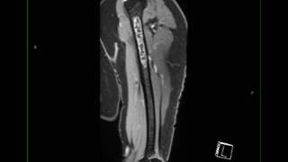 Conventional Chondrosarcoma Humerus [upl. by Ikkaj]