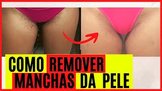 Como remover as manchas de Foliculite [upl. by Geirk]