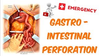 Gastrointestinal Perforation [upl. by Rodl]