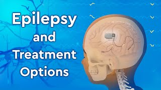 What is Epilepsy and How is it Treated [upl. by Errecart]